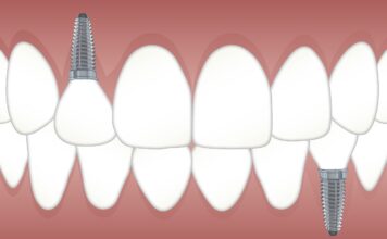 Implants dentaires – informations pratiques implant dentaire Paris